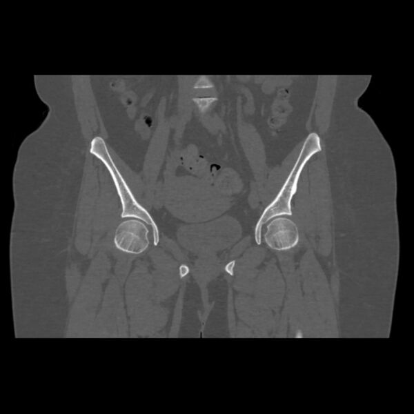 File:Calcific tendinitis of the gluteus medius muscle (Radiopaedia 66998-76318 Coronal bone window 24).jpg