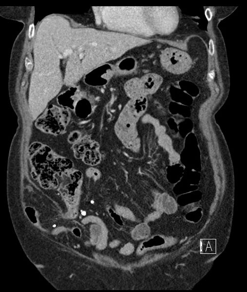 File:Calcified adrenal glands and Spigelian hernia (Radiopaedia 49741-54988 B 33).jpg