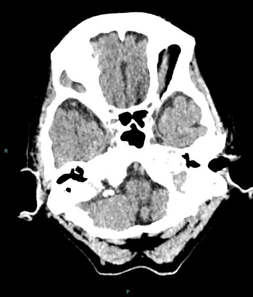 File:Calcified cerebral emboli from left ventricular thrombus (Radiopaedia 84420-99758 Axial non-contrast 75).jpg