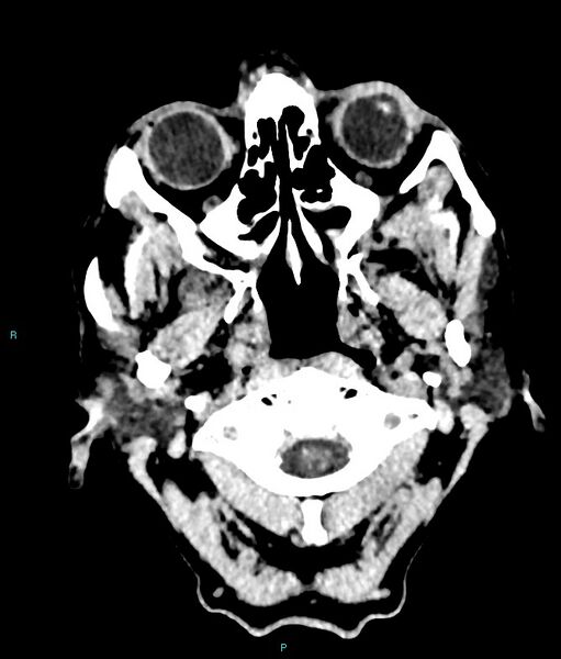 File:Calcified cerebral emboli from left ventricular thrombus (Radiopaedia 84420-99758 Axial non-contrast 89).jpg