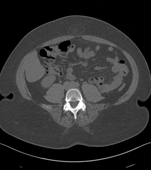 File:Calcified hepatic hydatid cyst (Radiopaedia 81127-94738 Axial non-contrast 62).jpg