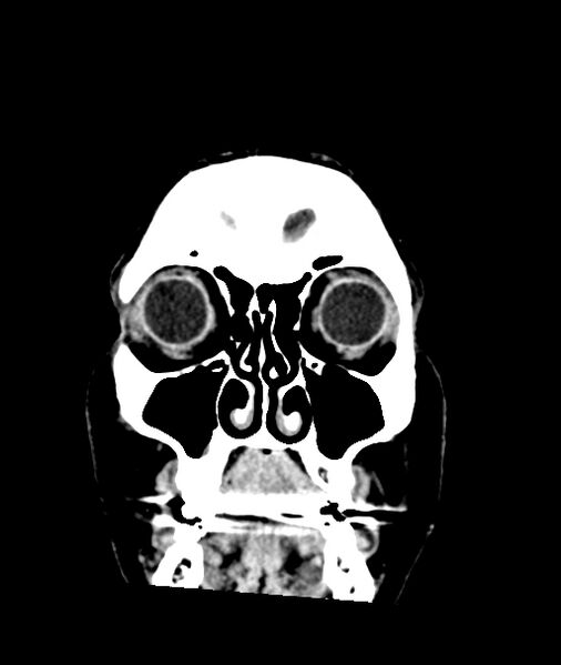 File:Calcified meningioma (Radiopaedia 74361-85243 Coronal non-contrast 2).jpg