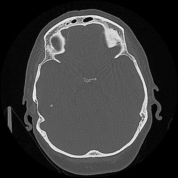 File:Canal up mastoidectomy (Radiopaedia 78108-90638 Axial bone window 115).jpg
