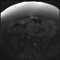 Cancer cervix - stage IIb (Radiopaedia 75411-86615 T1 fat sat 28).jpg