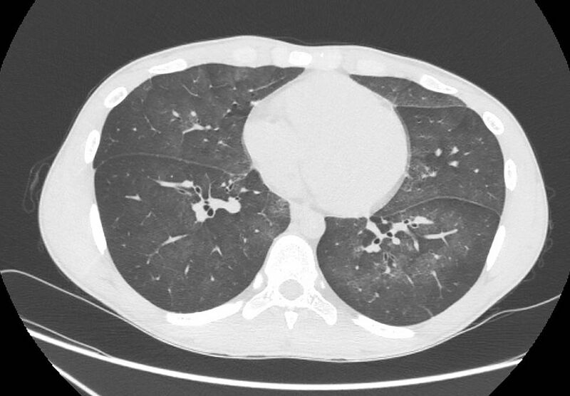 File:Cannabis-induced diffuse alveolar hemorrhage (Radiopaedia 89834-106946 Axial lung window 74).jpg