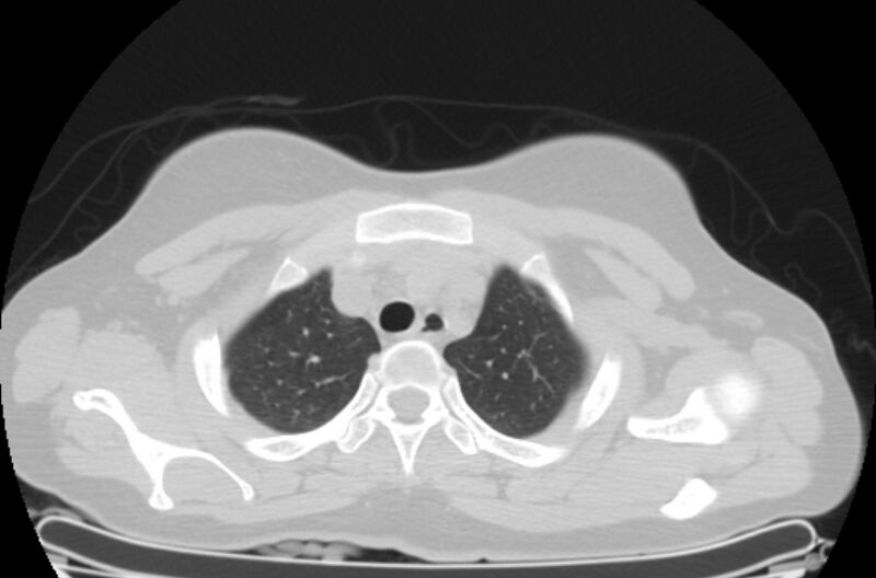 File:Cannonball metastases - uterine choriocarcinoma (Radiopaedia 70137-80173 Axial lung window 3).jpg