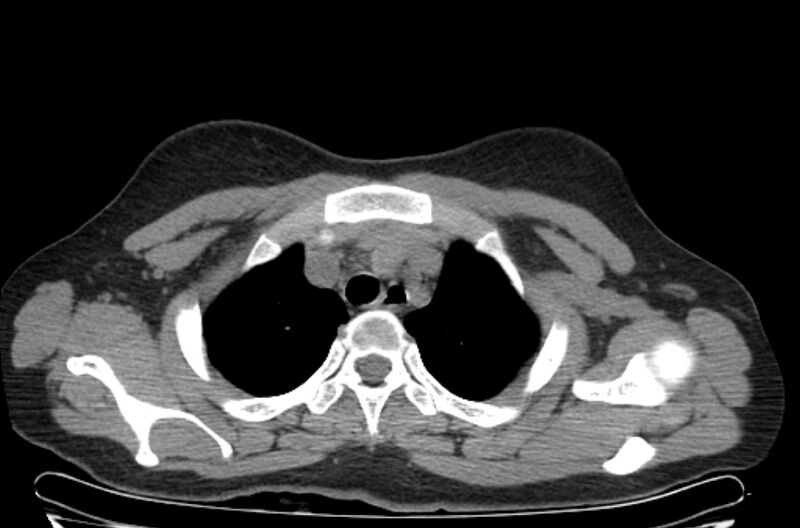 File:Cannonball metastases - uterine choriocarcinoma (Radiopaedia 70137-80173 Axial non-contrast 12).jpg