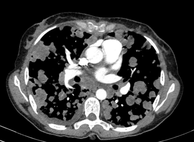 File:Cannonball metastases from breast cancer (Radiopaedia 91024-108569 A 61).jpg