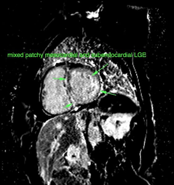 File:Cardiac amyloidosis (Radiopaedia 51404-57155 A 1).jpg