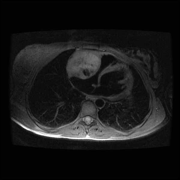 File:Cardiac paraganglioma (Radiopaedia 76345-88009 Axial T1 fat sat 8).jpg