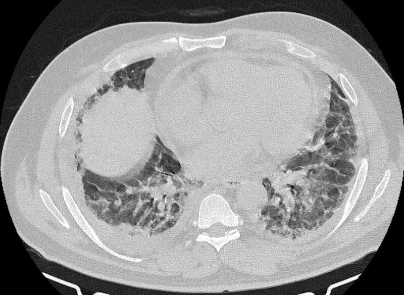 File:Cardiogenic pulmonary edema (Radiopaedia 68180-77678 Axial lung window 62).jpg