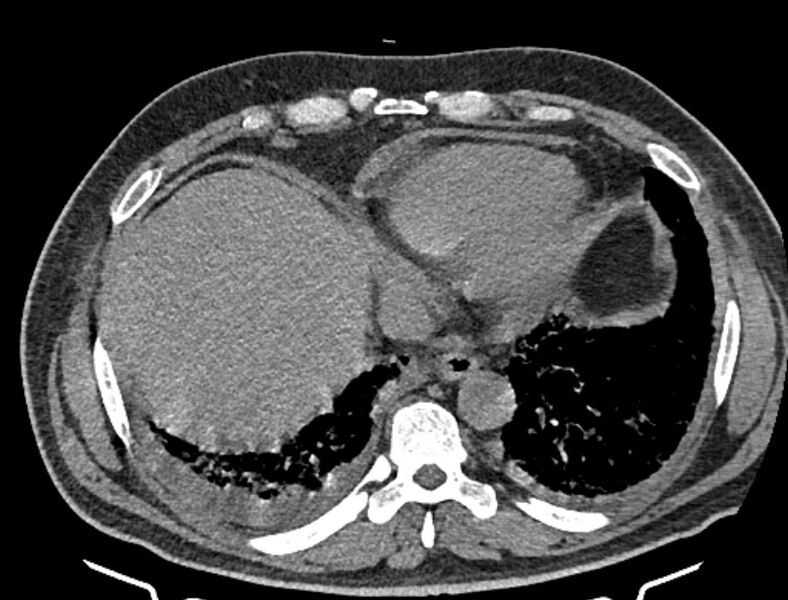 File:Cardiogenic pulmonary edema (Radiopaedia 68180-77678 Axial non-contrast 42).jpg