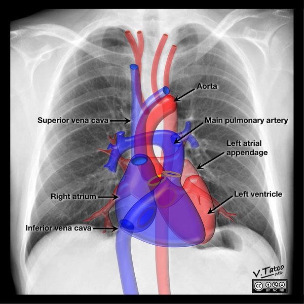 File:Cardiomediastinal anatomy on chest radiography (annotated images) (Radiopaedia 46331-50742 P 1).png