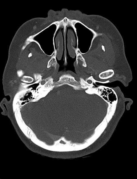 File:Causes of dysphagia (Radiopaedia 40149-42657 Axial bone window 7).png