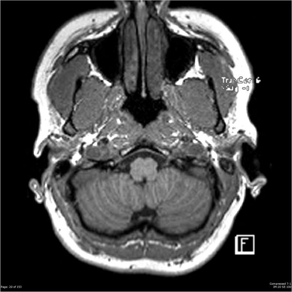 File:Cavernous malformation (cavernous angioma or cavernoma) (Radiopaedia 36675-38237 Axial T1 9).jpg