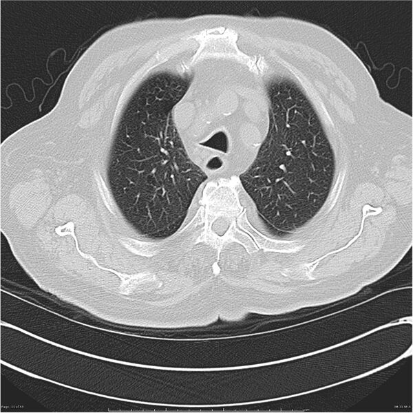 File:Cavitating left lower lobe lesion - squamous cell lung cancer (Radiopaedia 27749-28176 Axial lung window 11).jpg