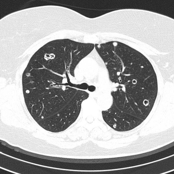 File:Cavitating pulmonary metastases (Radiopaedia 17796-17555 Axial lung window 6).jpg