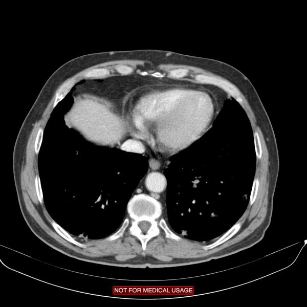 File:Cavitating pulmonary metastases (Radiopaedia 24920-25184 B 22).jpg