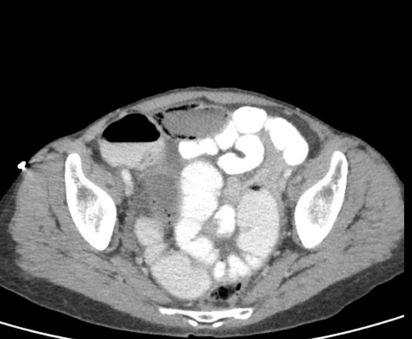 Cecal volvulus with pneumatosis coli (Radiopaedia 68572-78178 A 105).jpg