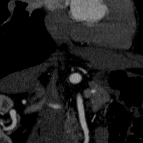 File:Celiac artery aneurysm (Radiopaedia 21574-21525 B 14).JPEG