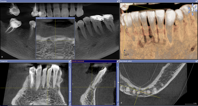 File:Cemento-osseous dysplasia (Radiopaedia 48251-53127 CBCT reconstruction 1).png