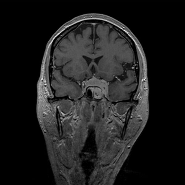 File:Central base of skull meningioma (Radiopaedia 53531-59549 Coronal T1 C+ 8).jpg
