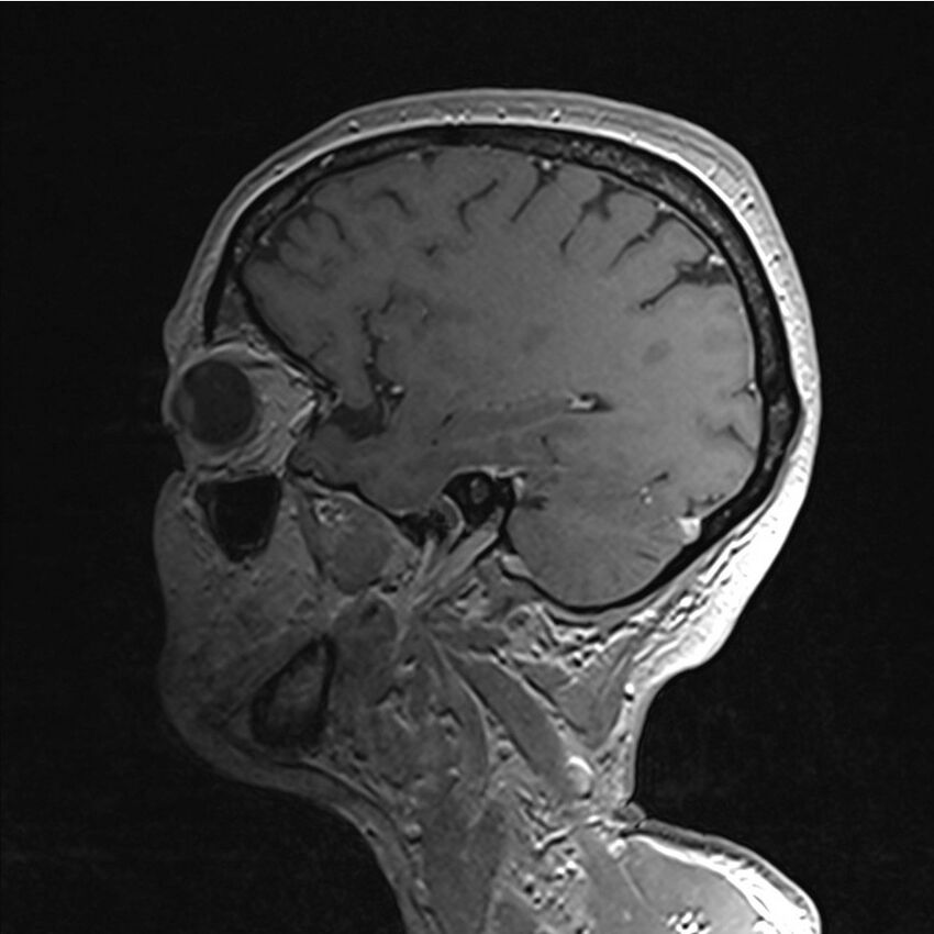 Central base of skull meningioma (Radiopaedia 53531-59549 Sagittal T1 C+ 60).jpg