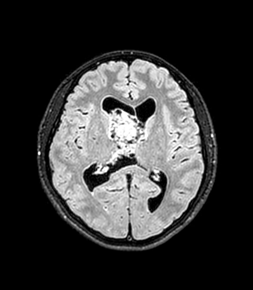 Central neurocytoma (Radiopaedia 79320-92380 Axial FLAIR 149).jpg
