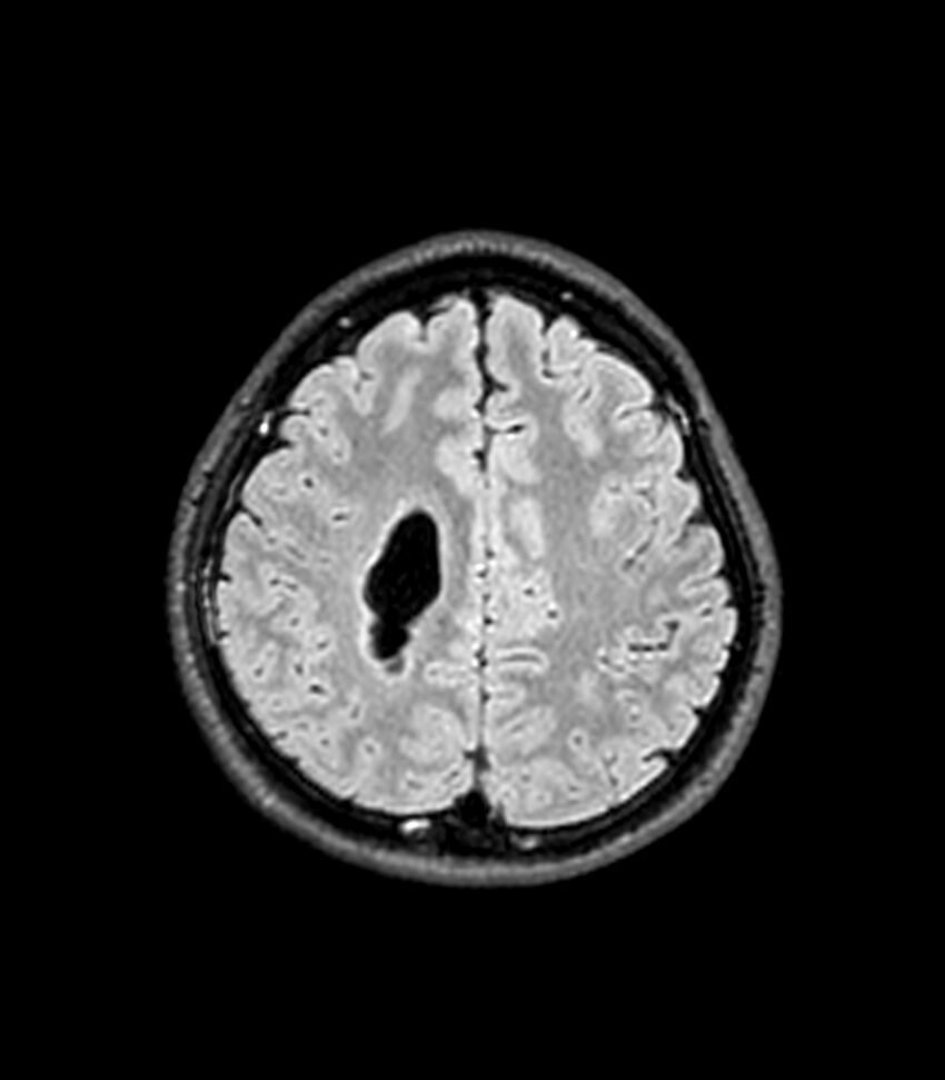 Central neurocytoma (Radiopaedia 79320-92380 Axial FLAIR 91).jpg