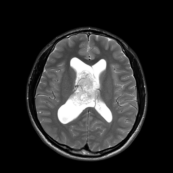File:Central neurocytoma (Radiopaedia 79320-92380 Axial T2 16).jpg