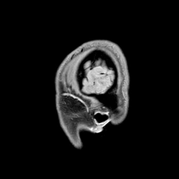 File:Central neurocytoma (Radiopaedia 79320-92380 Sagittal T1 244).jpg