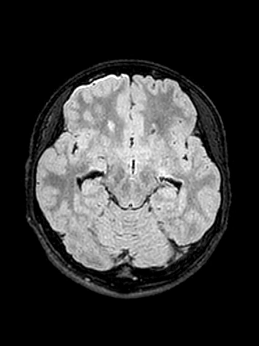 Central neurocytoma (Radiopaedia 79320-92381 Axial FLAIR 103).jpg