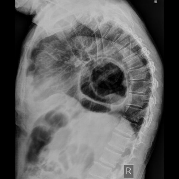 File:Central phrenic hernia (Radiopaedia 21404-21332 Lateral 1).JPEG