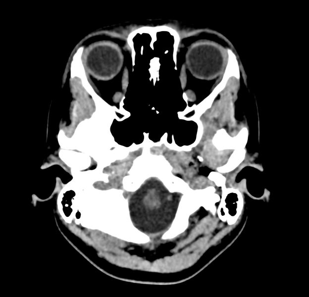 File:Cerebellar agenesis (Radiopaedia 30203-30817 Axial non-contrast 4).jpg