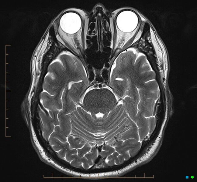 File:Cerebellar gangliocytoma (Radiopaedia 65377-74422 Axial T2 12).jpg