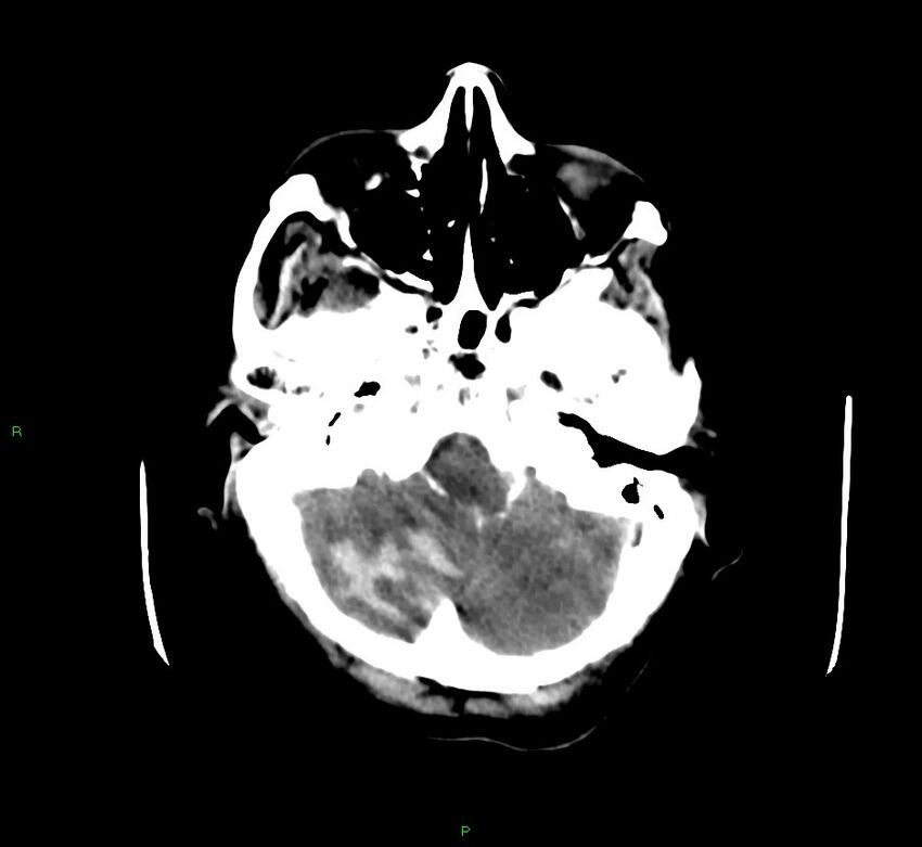 Cerebellar hemorrhage (Radiopaedia 58792-66026 Axial non-contrast 42).jpg