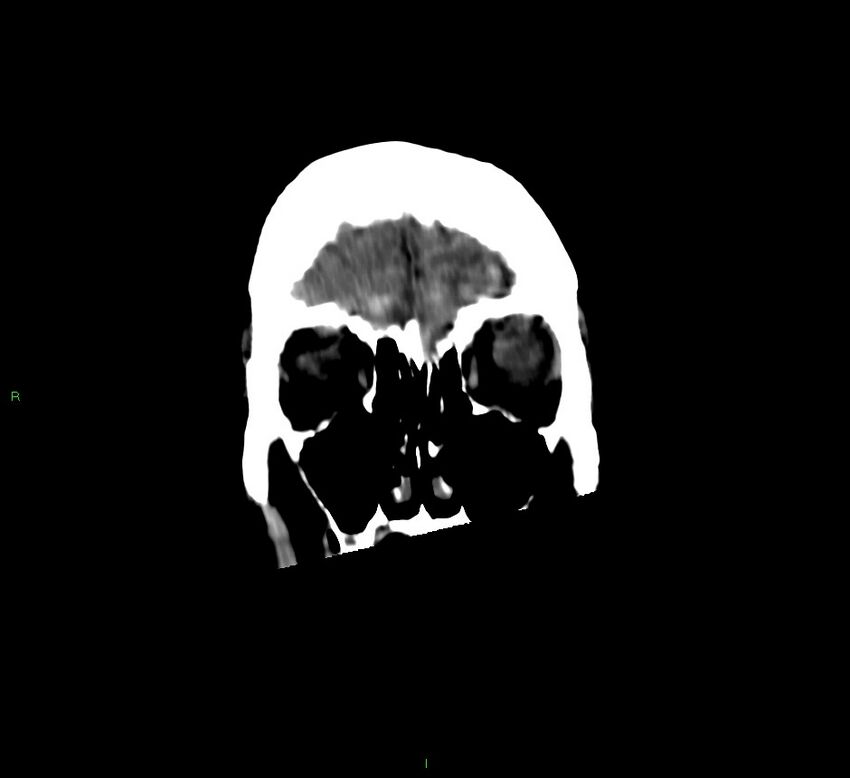 Cerebellar hemorrhage (Radiopaedia 58792-66026 Coronal non-contrast 54).jpg