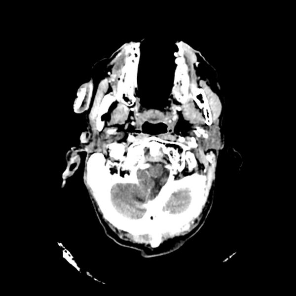 File:Cerebellar metastasis - lung tumor (Radiopaedia 69317-79145 Axial with contrast 4).jpg