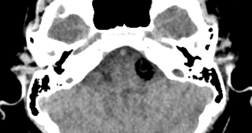 Cerebellopontine angle lipoma (Radiopaedia 57303-64242 B 26).jpg