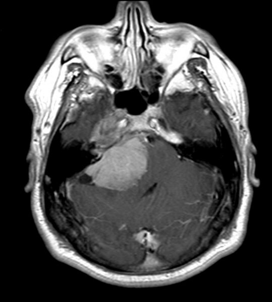 File:Cerebellopontine angle meningioma (Radiopaedia 24459-24764 Axial T1 C+ 7).jpg