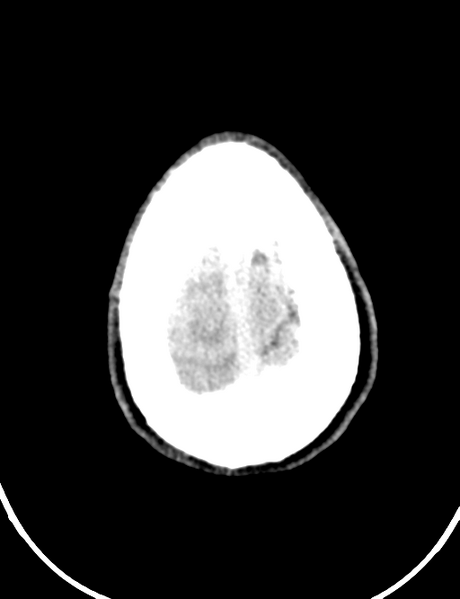 File:Cerebral abscess (Radiopaedia 60342-68008 Axial non-contrast 48).png