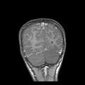 Cerebral abscess post cardiac surgery (Radiopaedia 27244-27420 Coronal T1 C+ 20).jpg
