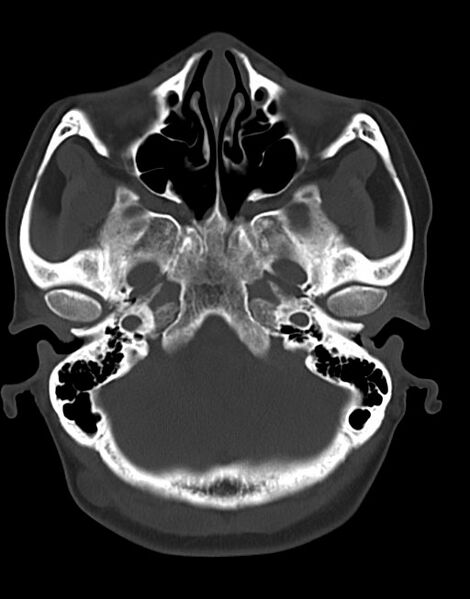 File:Cerebral abscesses (Radiopaedia 70458-80568 Axial bone window 15).jpg