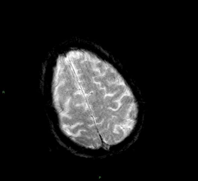 File:Cerebral amyloid angiopathy-associated lobar intracerebral hemorrhage (Radiopaedia 58377-65515 Axial Gradient Echo 7).jpg