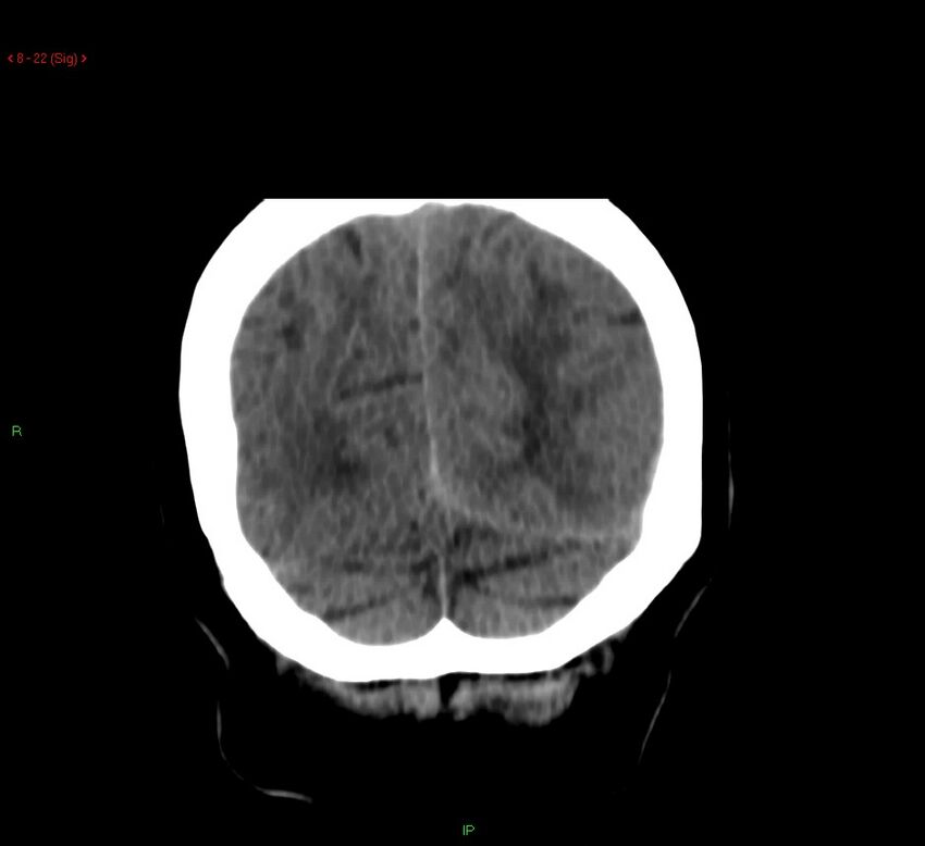 Cerebral amyloid angiopathy-associated lobar intracerebral hemorrhage (Radiopaedia 58378-65518 Coronal non-contrast 22).jpg