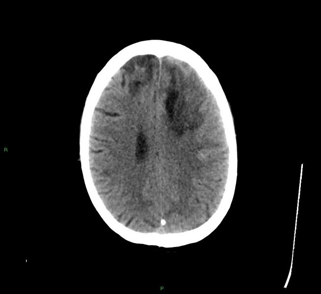 File:Cerebral amyloid angiopathy-associated lobar intracerebral hemorrhage (Radiopaedia 58529-65681 Axial non-contrast 17).jpg