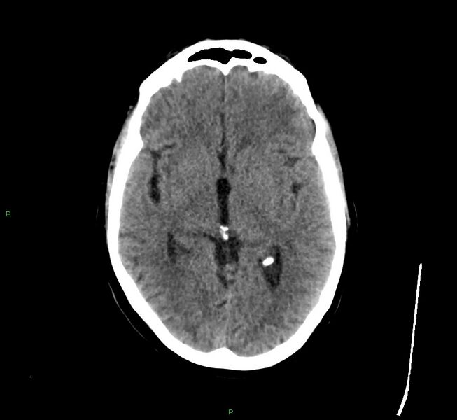 File:Cerebral amyloid angiopathy-associated lobar intracerebral hemorrhage (Radiopaedia 58529-65681 Axial non-contrast 29).jpg