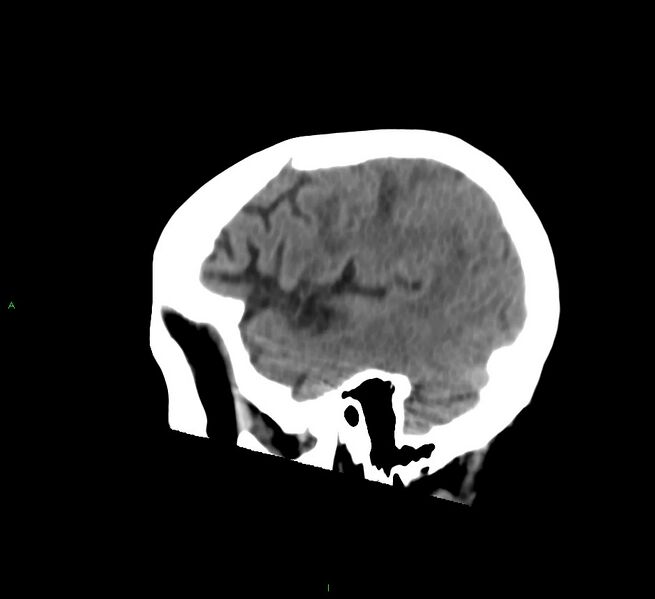 File:Cerebral amyloid angiopathy-associated lobar intracerebral hemorrhage (Radiopaedia 58530-65688 C 44).jpg