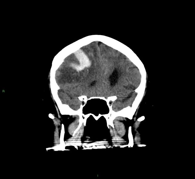File:Cerebral amyloid angiopathy-associated lobar intracerebral hemorrhage (Radiopaedia 58560-65723 Coronal non-contrast 48).jpg