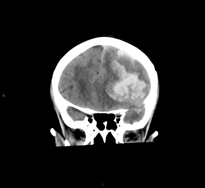 File:Cerebral amyloid angiopathy-associated lobar intracerebral hemorrhage (Radiopaedia 58561-65724 Coronal non-contrast 43).jpg